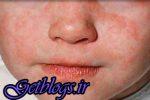 کنترل تردد اتباع کشورهای همجوار ، برنامه از بین بردن سرخک